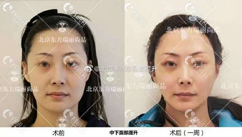 北京东方瑞丽李晓东做PST面部提升案例前后对比