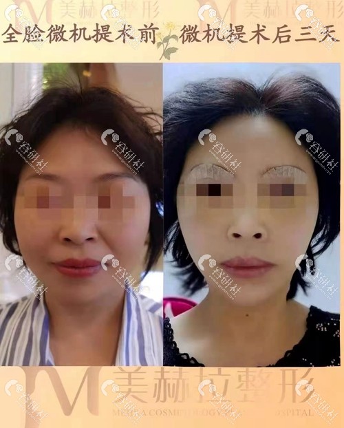 西安吉美赫拉医疗美容面部提升前后效果对比