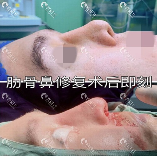 新疆库尔勒奥蕊斯屈兴明肋软骨鼻修复前后对比照片