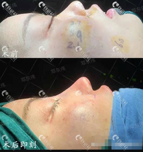 成都西区邓东伟医生做鼻综合手术即刻