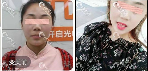 东营芮颜医疗美容门诊部下巴日记