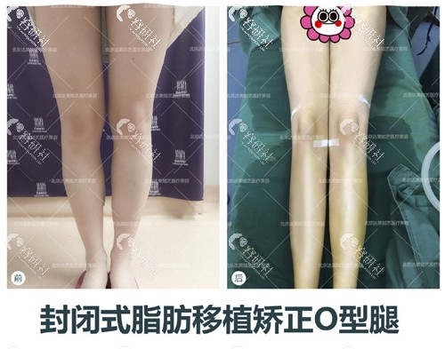 北京达美如艺医疗美容谷廷敏脂肪移植矫正O型腿前后对比照片