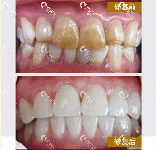 氟斑牙瓷贴面修复前后对比照片