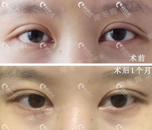 北京尚益嘉容常冬青双眼皮修复前后对比