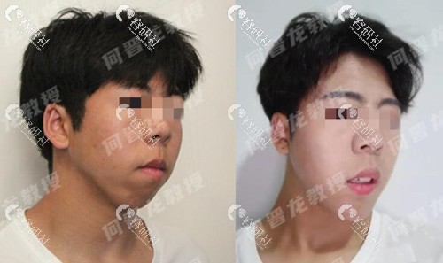 上海时光何晋龙凸嘴正颌手术前后对比图