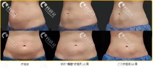 酷塑冷冻减脂瘦腰腹部治疗前和12周后图片