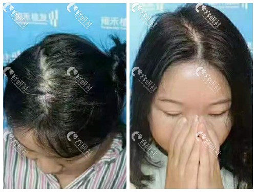 徐州雍禾发缝加密种植图片分享