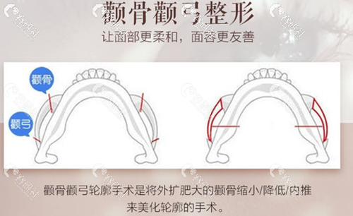 上海愉悦美联臣颧骨颧弓整形示意图