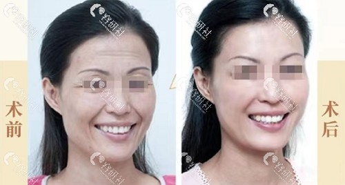 广州中家医家庭医生黄广香拉皮手术前后对比图