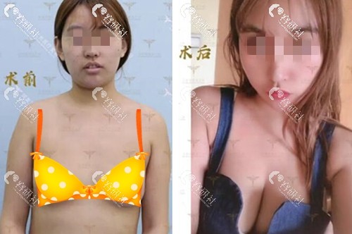 北京润美玉之光朱金成自体脂肪隆胸前后对比图