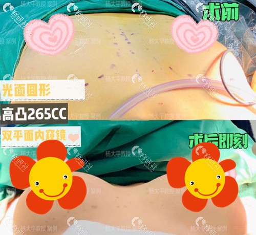 北京联合丽格杨大平假体隆胸前后对比图