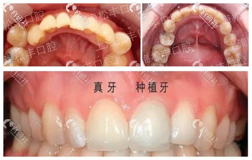 上海松丰齿科种植牙和牙齿矫正案例分享
