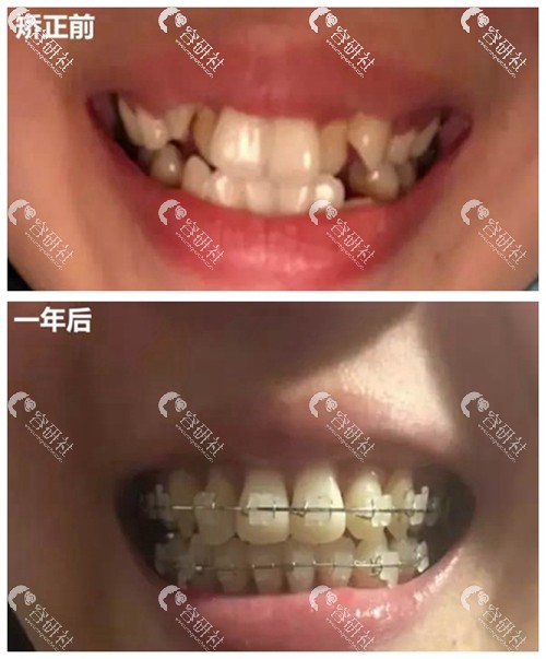 上海维佳康口腔医院牙齿矫正一年前后对比