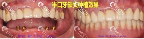 上海拜博口腔医院半口种植案例前后对比