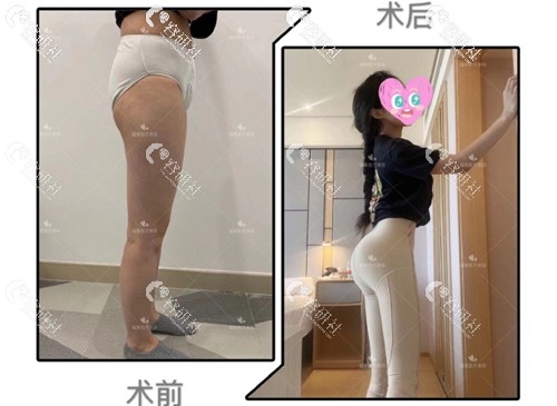 深圳福雅胡俊杰假体丰臀前后对比