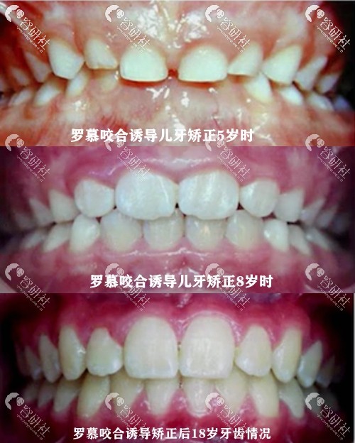 罗慕咬合诱导治疗8-18岁的牙齿生长情况