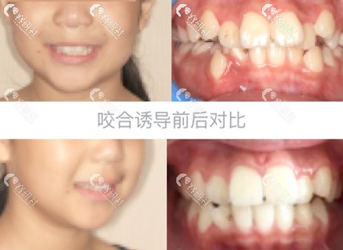 ETA功能性矫治器治疗牙齿排列不整齐前后对比