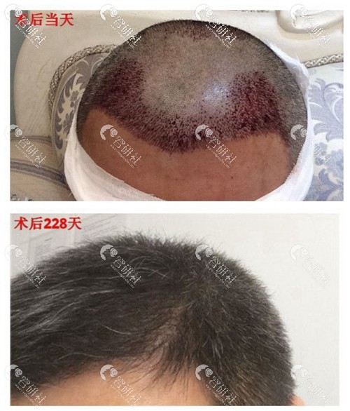 深圳大麦植发医院植发前后对比
