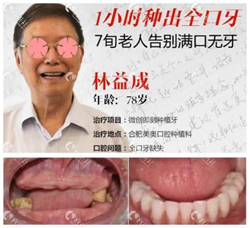 合肥美奥口腔医院全口种植牙案例前后对比