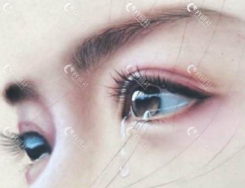 割双眼皮失败后痛哭伤心，上海杜园园双眼皮修复好吗？