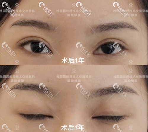 上海联合丽格医疗美容杜园园双眼皮失败修复术后1年图片