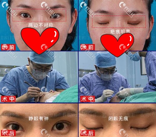南京医科大学友谊整形外科割双眼皮真人日记