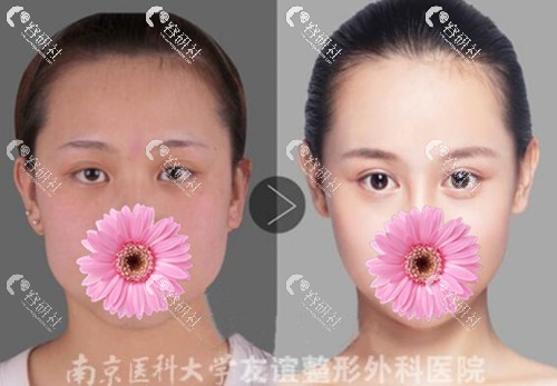 南京医科大学友谊整形外科割双眼皮案例效果图