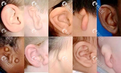 不同类型的先天性小耳畸形表现