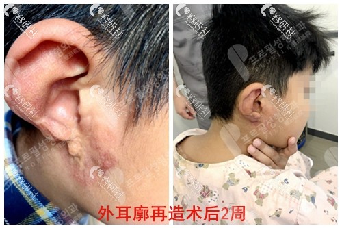 郑在皓外耳廓再造术前和术后2周对比图