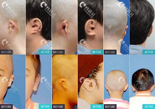 韩国普罗菲耳profile医院外耳廓重建手术案例