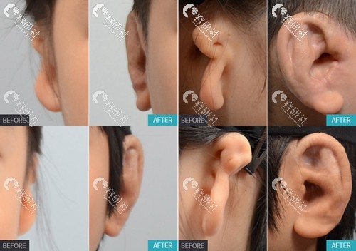 韩国普罗菲耳外耳廓再造+听力重建手术案例