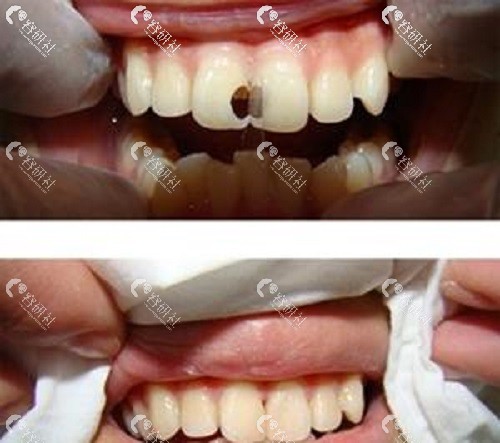 漳州康桥口腔门诊补牙前后对比照片