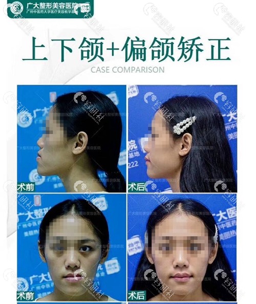 广州广大整形医院何锦泉医生做偏颌歪脸正颌案例对比