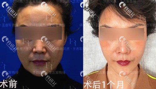 北京联合丽格第二医疗美容王志军拉皮手术前后对比图