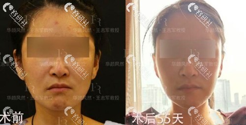 北京联合丽格第二医疗美容王志军拉皮手术案例效果图