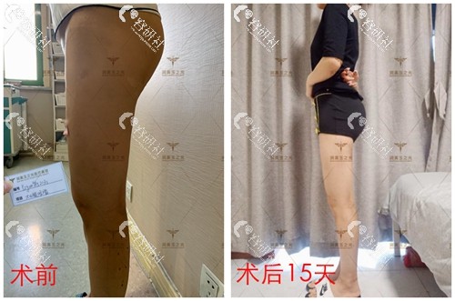 北京润美玉之光朱金成大腿吸脂案例