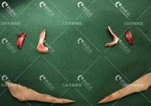 上海九院韦敏教授手术中切割下来的下颌角
