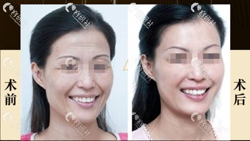 广州中家医家庭医生整形美容医院面部提升前后对比照片