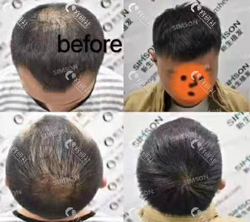南京新生植发头顶加密种植一年后对比效果