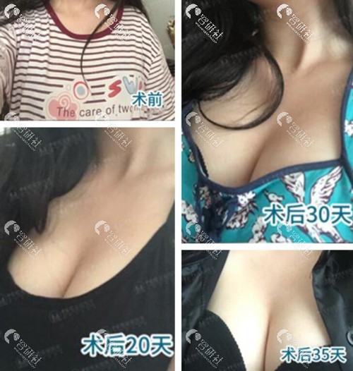 广州中家医家庭医生黄广香隆胸前后对比图
