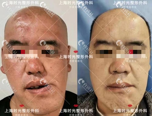 上海时光何晋龙正颌术前术后对比图
