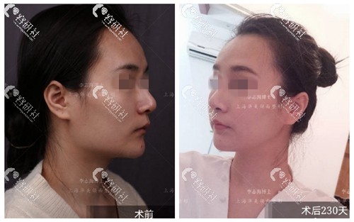 上海华美李志海下颌角手术前后对比