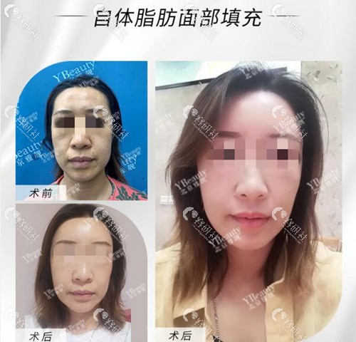 北京雅靓张春彦面部脂肪填充术前术后对比图