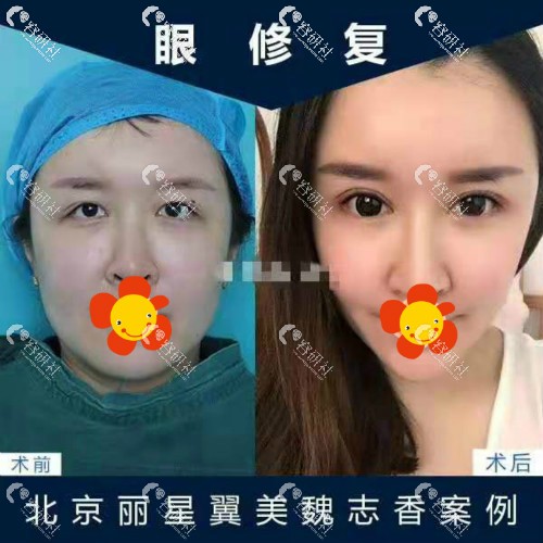 北京丽星翼美医疗美容双眼皮修复案例