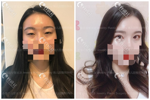 韩国珠儿丽医院双眼皮修复案例