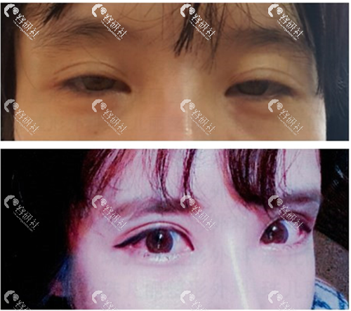 韩国珠儿丽医院双眼皮修复日记