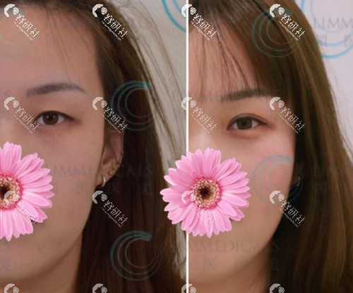 北京领医日式双眼皮日记效果图