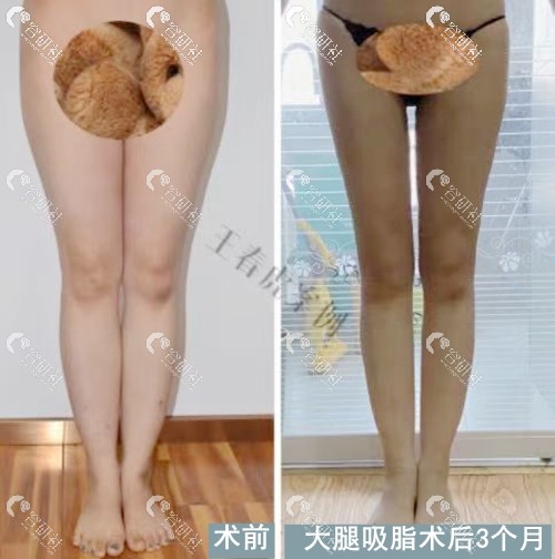 北京八大处王春虎医生大小腿吸脂图片