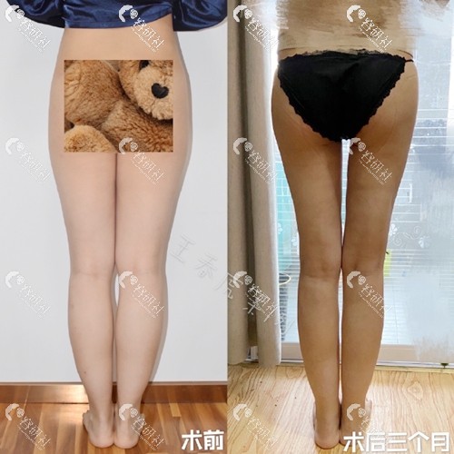 北京八大处王春虎大小腿吸脂术前术后3个月背面对比图