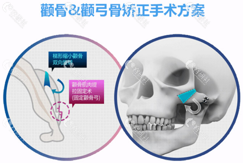 上海华美颧骨缩小手术方法